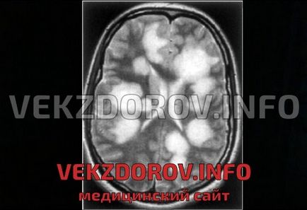 Які демієлінізуючі захворювання відомі, крім розсіяного склерозу