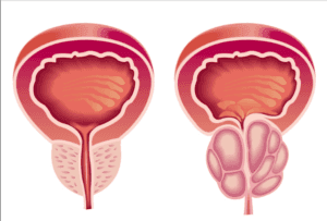 Ce boli afectează potența, influența rinichilor și a psoriazisului asupra potenței, adenomului și prostatei de prostată