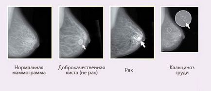 Як результати мамографії розшифрувати