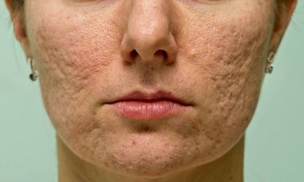 Cum să eliminați cicatricile acneei pe fața dumneavoastră acasă