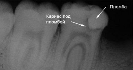 Карієс під пломбою діагностика, способи лікування і профілактика захворювання
