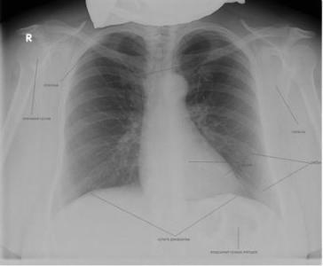 Каталог рентгенологічних знімків легких