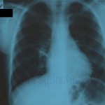 Каталог рентгенологічних знімків легких