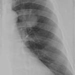 Katalógus röntgen képeket, a tüdő