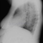 Katalógus röntgen képeket, a tüdő