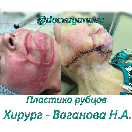 Tratamentul cicatricelor cicatrice, după, foto, revista online