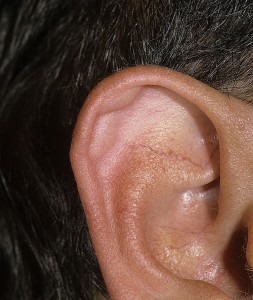 Chistul unei urechi false - cauze, simptome, tratament, fotografie