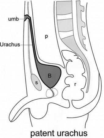 Chistul Urchus și celelalte patologii ale acestuia la clasificarea, cauzele, simptomele, tratamentul bărbaților și femeilor