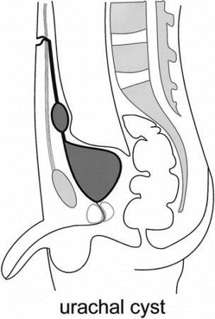 Кіста урахуса і його інші патології у чоловіків і жінок класифікація, причини, симптоми, лікування