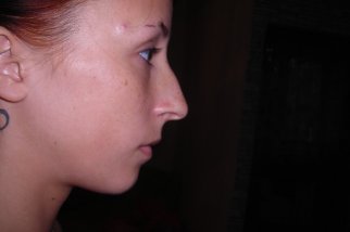 Modelarea computerizată înainte de rinoplastia nasului