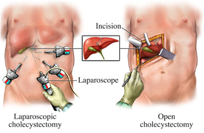 Лапароскопія пахової грижі, операція з мінімальними надрізами і шрамами