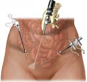 Лапароскопія при грижі - що це таке, ціни, відео