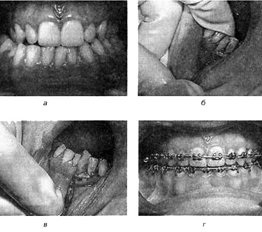 Лікування дістопіі - стоматологія - хірургія і лікування