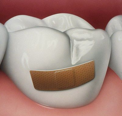A kezelés a fogszuvasodás