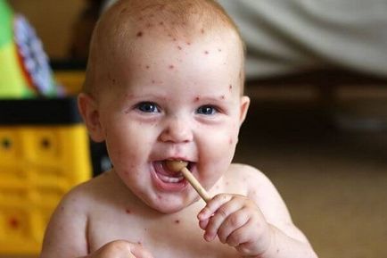Tratamentul varicelei la copii fără verde, droguri și sfaturi