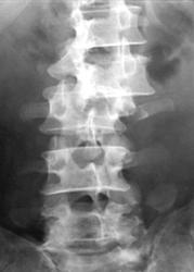 Radiodiagnostics - stabil és instabil károsodás mellkasi és ágyéki gerinc (gerincvelői komponensek) Radiodiagnostics - stabil és instabil elváltozások mellkasi és ágyéki gerinc