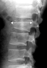 Diagnosticarea radiațiilor - leziuni stabile și instabile ale diviziunilor toracice și lombare