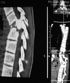 Diagnosticarea radiațiilor - leziuni stabile și instabile ale diviziunilor toracice și lombare