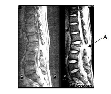 Diagnosticarea radiațiilor - leziuni stabile și instabile ale diviziunilor toracice și lombare