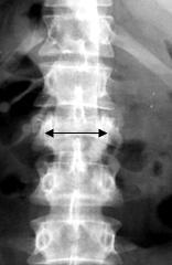 Diagnosticarea radiațiilor - leziuni stabile și instabile ale diviziunilor toracice și lombare