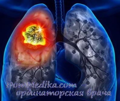 Radioterapia cancerului pulmonar