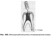 Tehnica de prelucrare instrumentală a canalelor radiculare