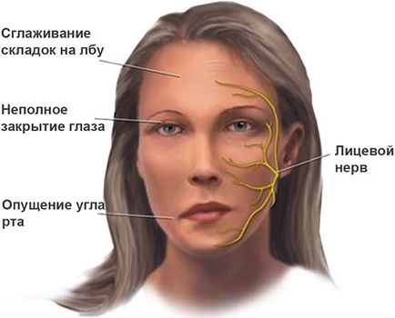 Myasthenia gravis contraindicații majore, nutriție și tratament, efect asupra sarcinii