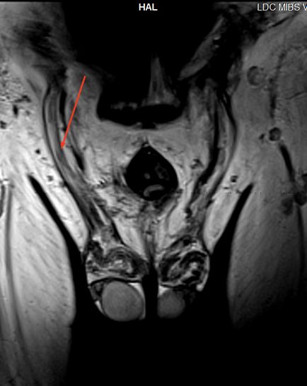 MRI a herezacskó és inguinalis csatorna