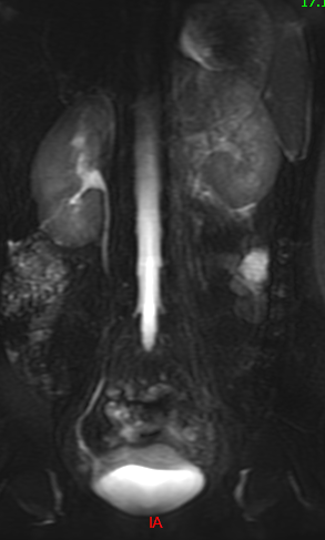 MRI retroperitonealis