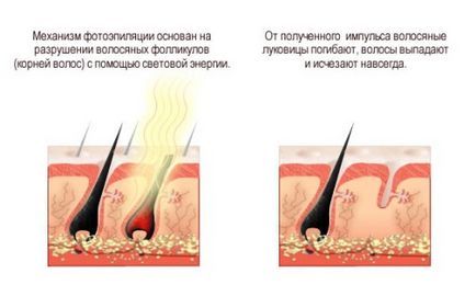 Férfi szőrtelenítés intim területek szőrtelenítés a bikinivonal és az ágyék