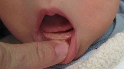 Нежить при прорізуванні зубів у маленьких дітей