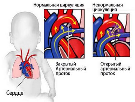 Trunchi arterial comun - cauze, simptome și tratament