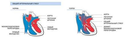 Truncus arteriosus - okai, tünetei és kezelése