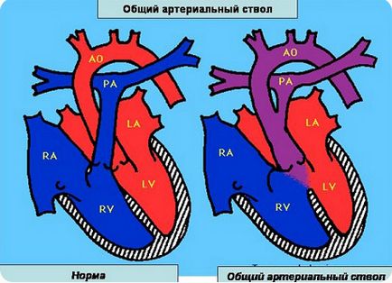 Truncus arteriosus - a betegség tüneteit, megelőzésére és kezelésére a közös artériás törzs,