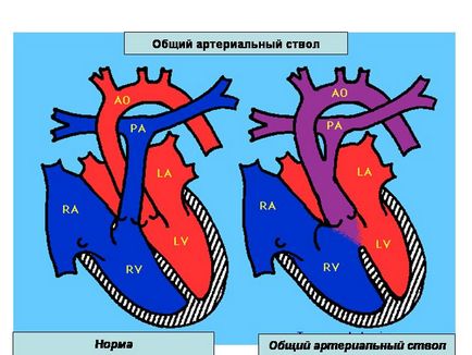 Truncus arteriosus a magzatban, az újszülöttben anomália besorolás