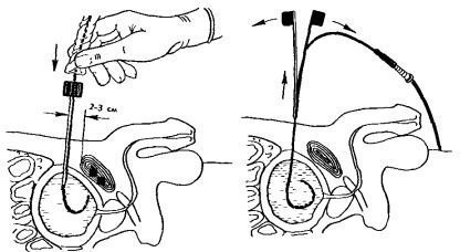 Tratamentul operativ al hiperplaziei benigne de prostată (adenom)