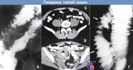 Tumorile intestinului subțire - frecvența, diagnosticul, tratamentul