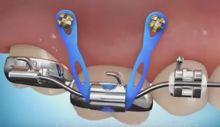 Indicatii implanturi ortodontice si contraindicatii pentru instalare