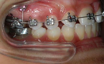 Ортодонтичні імпланти показання і протипоказання до установки