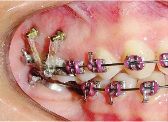Indicatii implanturi ortodontice si contraindicatii pentru instalare