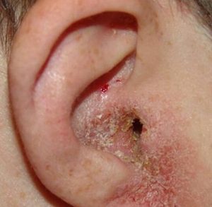 Simptomele otomicozei și tratamentul unei ciuperci urechii