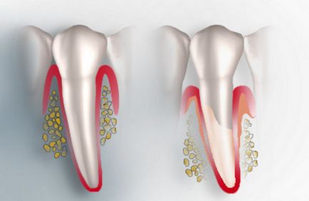 Periodontită, forme, cauze și simptome, diagnostic, tratament și prevenire, medicină populară