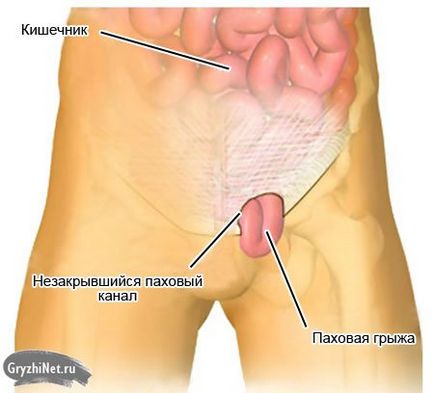 Hernia inghinala la fete, simptome, tratament (foto)