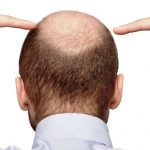 Пересадка волосся на голові ціна послуг, підрахунок графтов за умови ризику