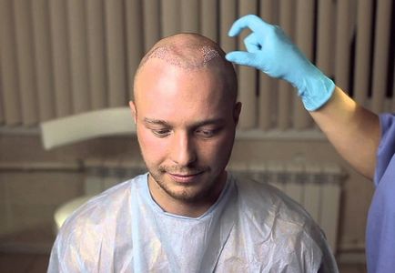 Transplantul de păr pe prețul capului serviciilor, numărarea grefelor, factorii care influențează