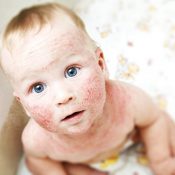 Періоральний дерматит у дитини і лікування у дітей
