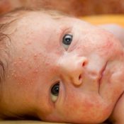 Dermatita dermatală la copii și tratamentul la copii