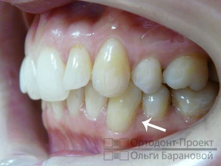 Підготовка місця для зубного імпланта за допомогою брекет-системи «інкогніто»