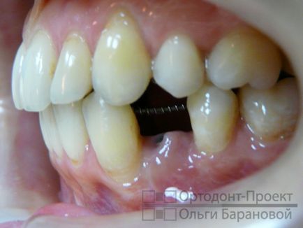 Pregătirea unui loc pentru un implant dentar cu ajutorul unui sistem de consolare 