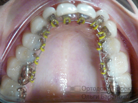 Підготовка місця для зубного імпланта за допомогою брекет-системи «інкогніто»